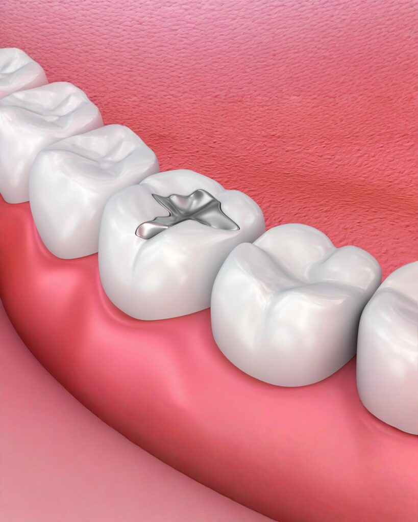 dental fillings