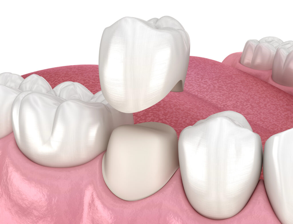 Dental crowns | dental services Brickfields