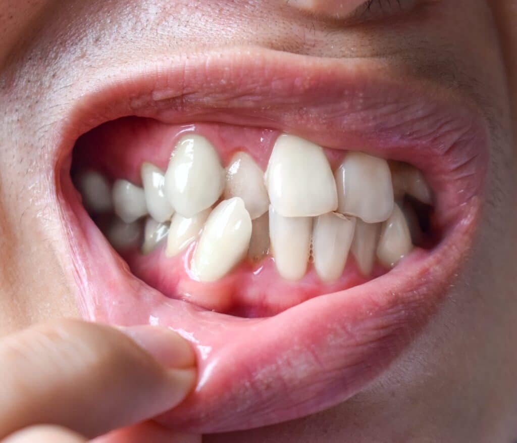 Orthodontic Dentistry 5 bite correction | orthodontic treatment