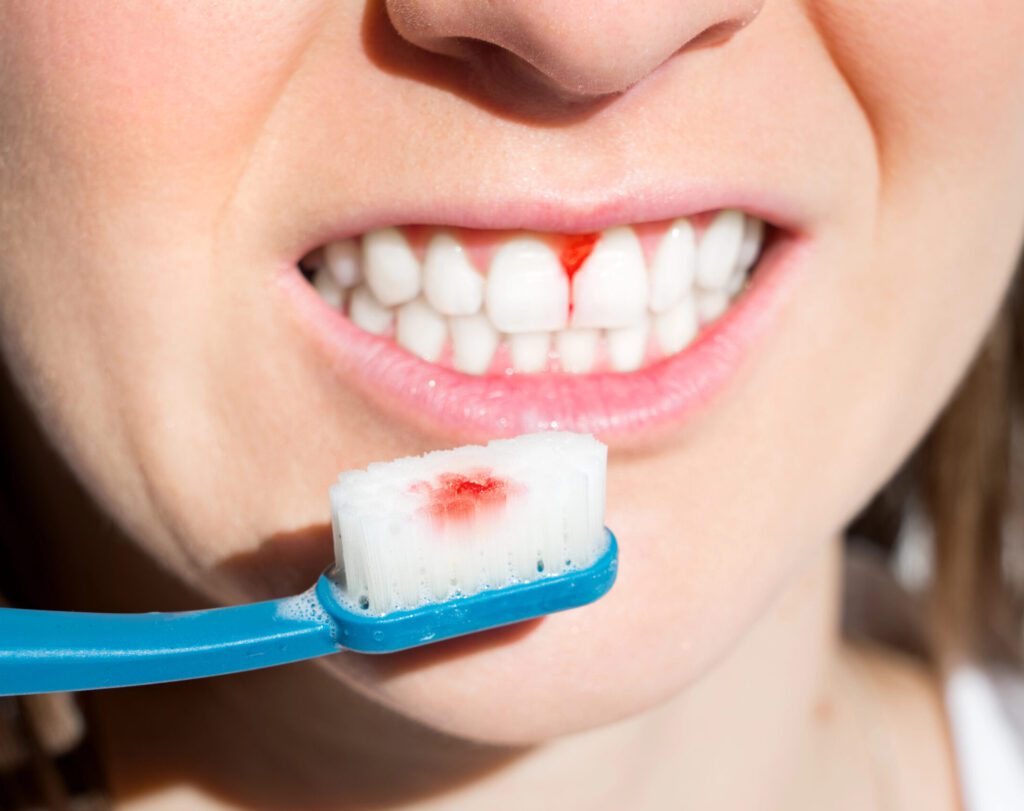 bleeding gums | dental problems we treat
