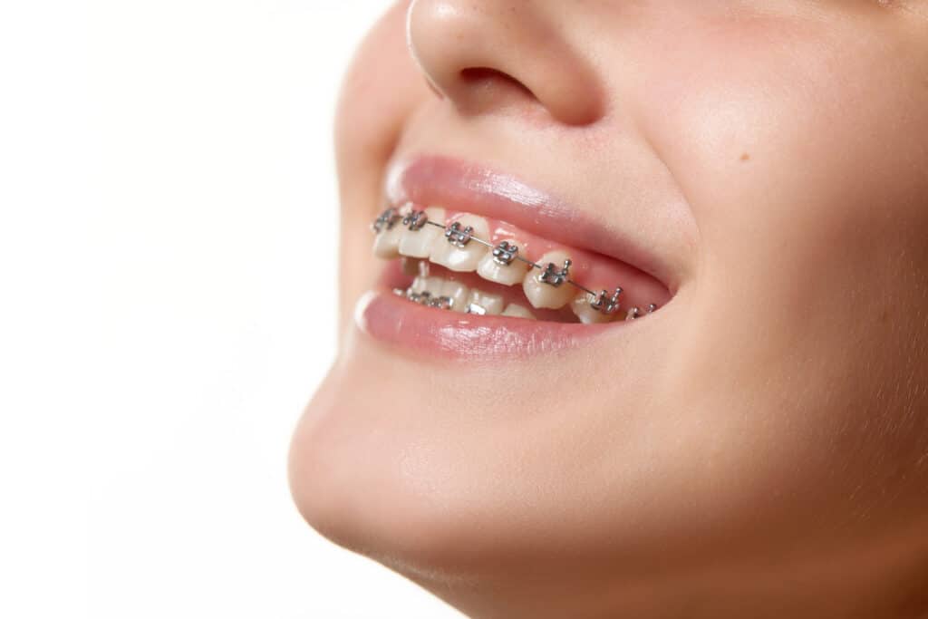 Orthodontic Dentistry 2 dental braces