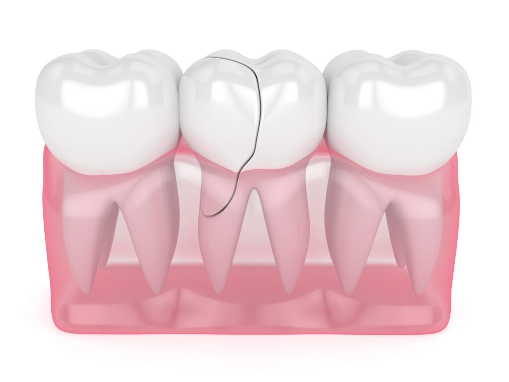 Chipped Tooth | Problems we Treat