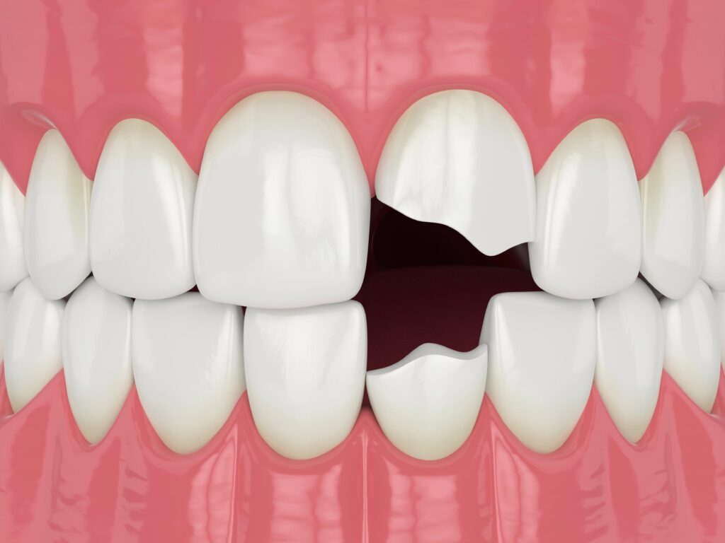 Cosmetic Dentistry 5 Dental bonding | Cosmetic Dentistry