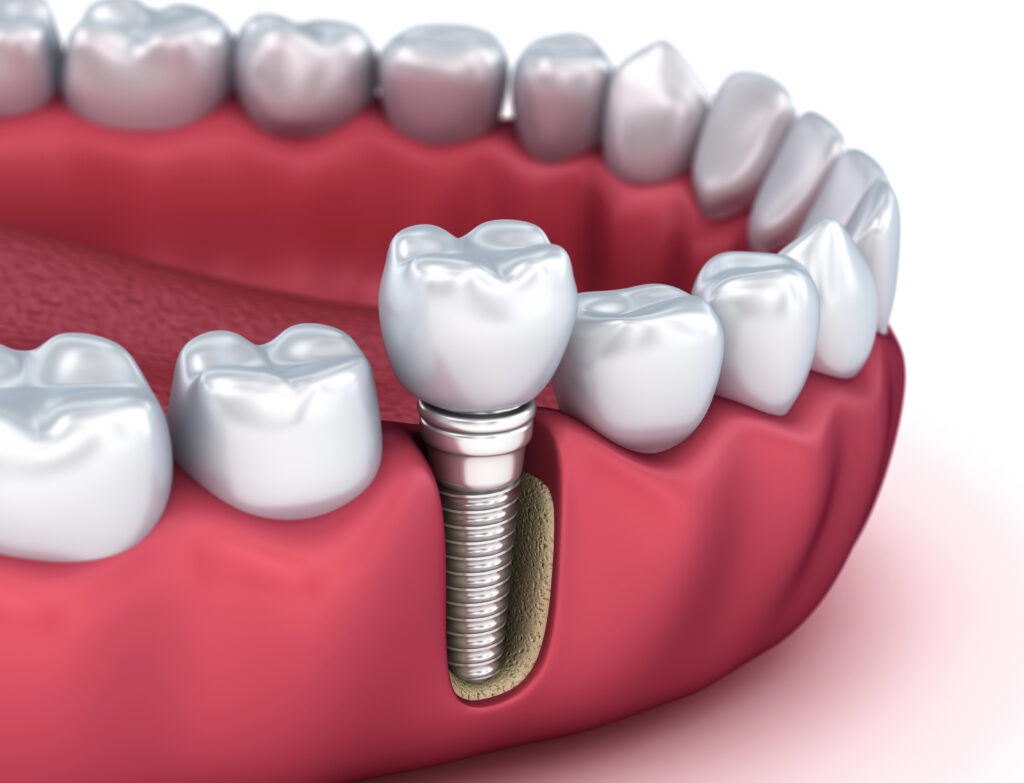Surgical Dentistry 2 surgical dentistry | dental implants