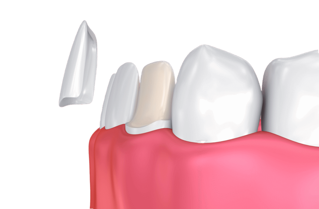 Cosmetic Dentistry 3 dental veneers