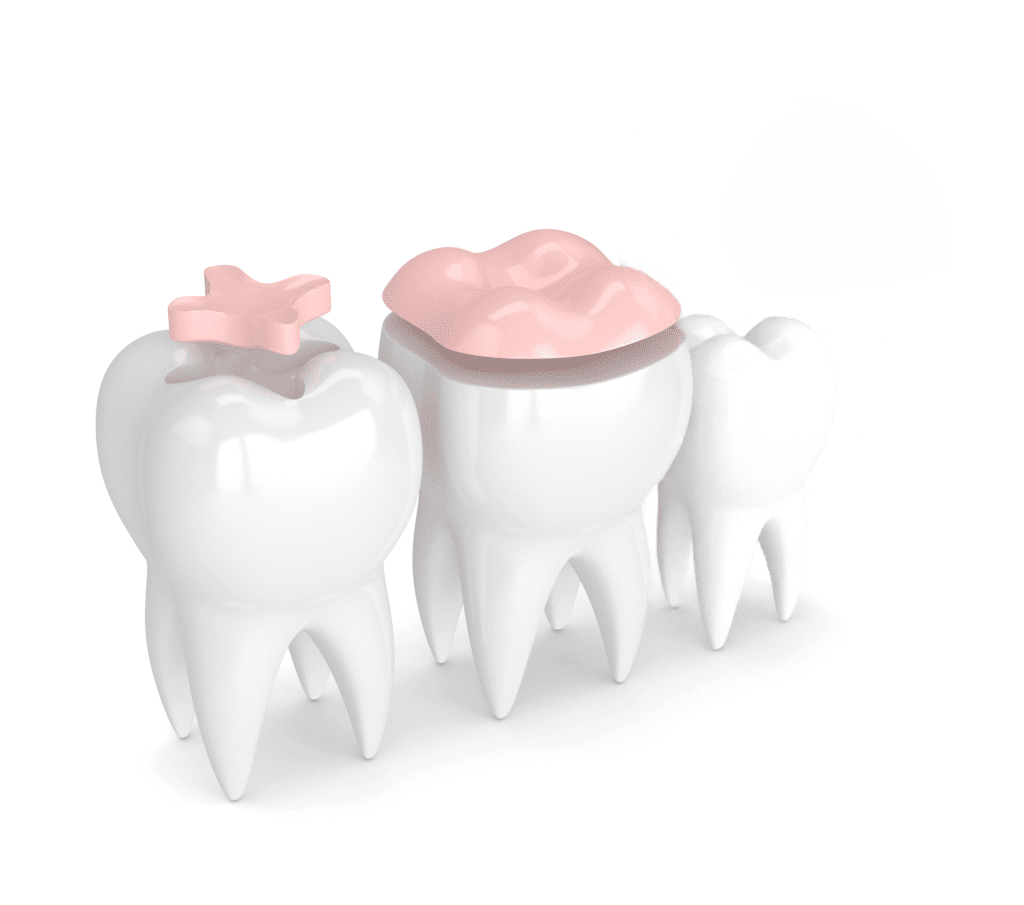 Cosmetic Dentistry 4 inlays and onlays