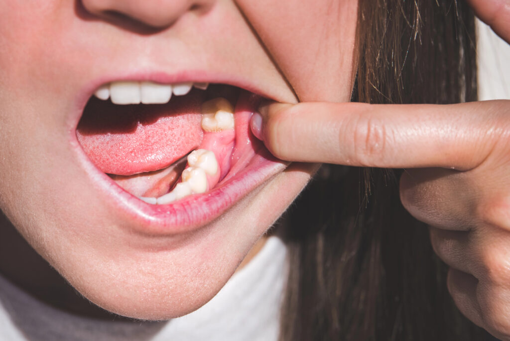 Missing tooth | Problems we treat at Nair Dental