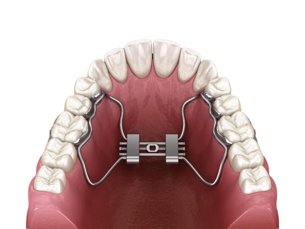 Orthodontic Dentistry 6 Palate Expansion b