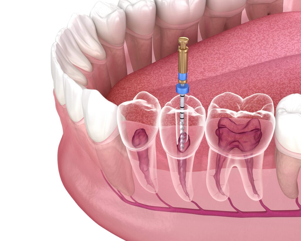 Surgical Dentistry 3 root canal | surgical dentistry