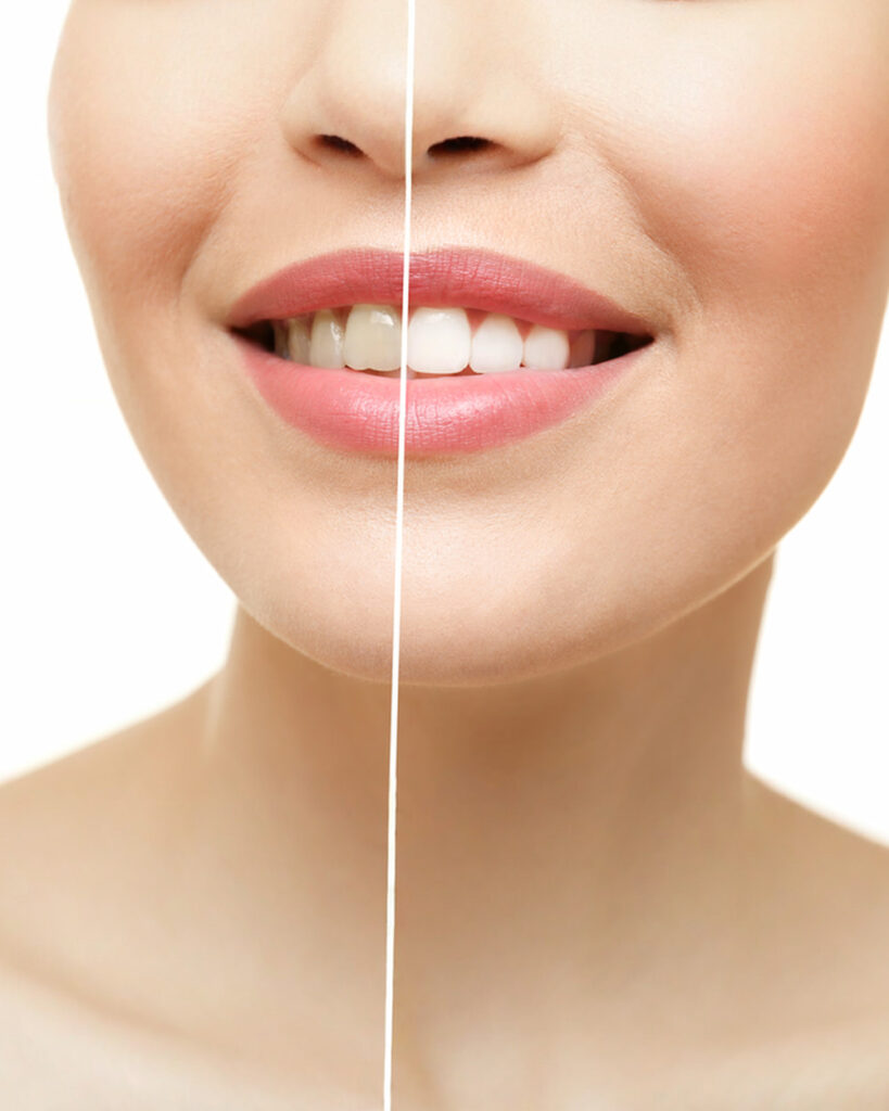 Stained Teeth