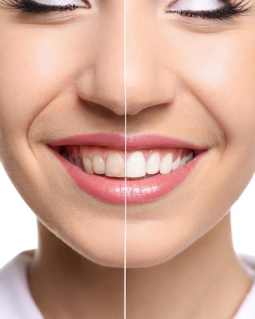 Cosmetic Dentistry 2 teeth whitening | cosmetic dentistry services Brickfields