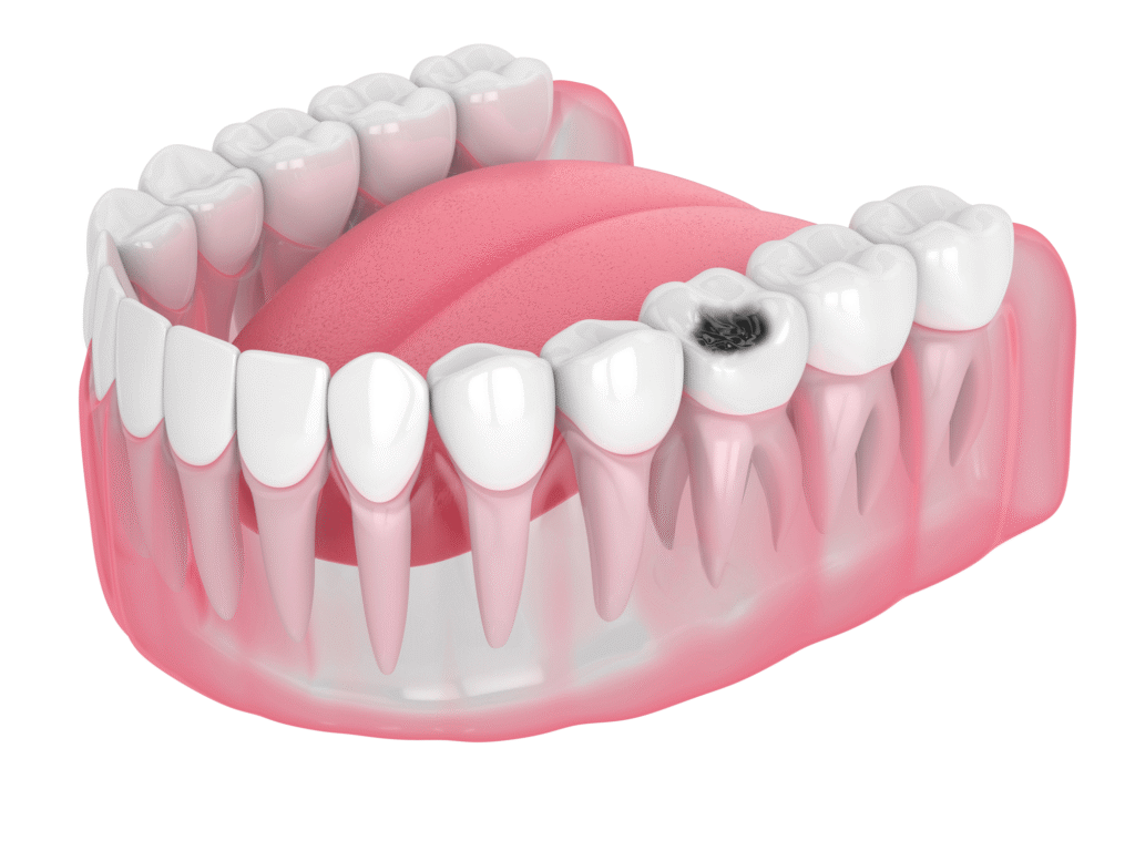 tooth cavity