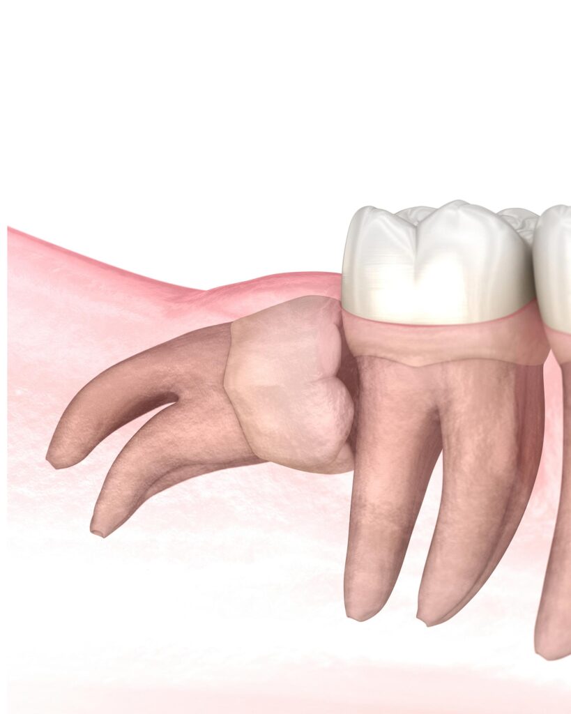 wisdom tooth pain | problems we treat at nair dental